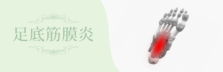 足底筋膜炎